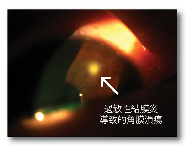 眼表眼角膜