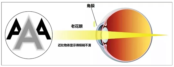 白内障