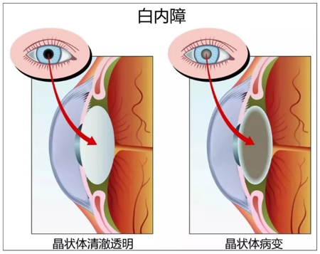 白内障