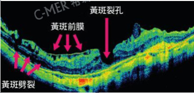 玻璃体视网膜