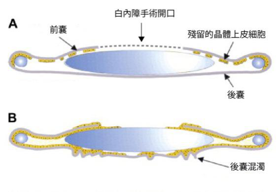 白内障
