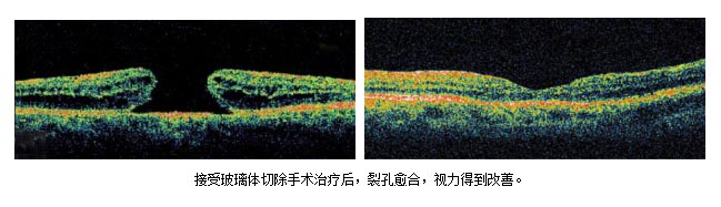 玻璃体视网膜