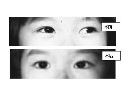 小儿眼病