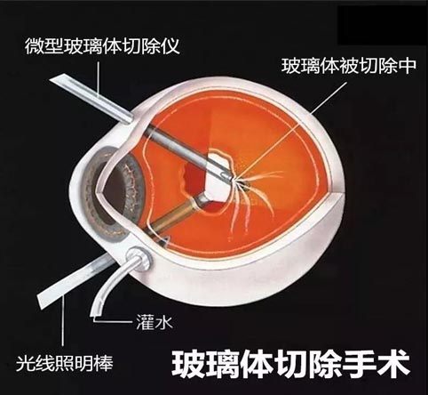 玻璃体视网膜