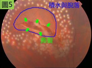 玻璃体视网膜