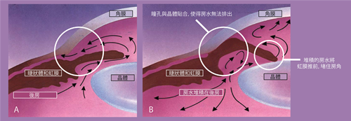 青光眼