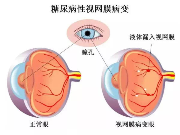 玻璃体视网膜
