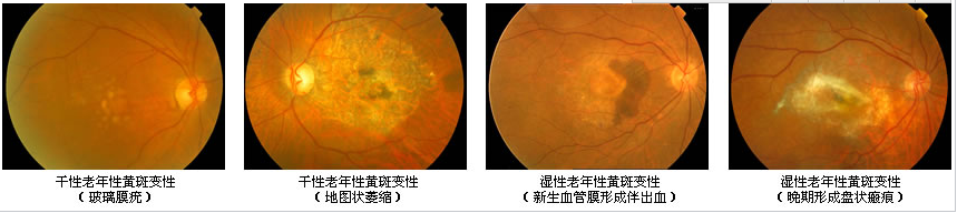 玻璃体视网膜