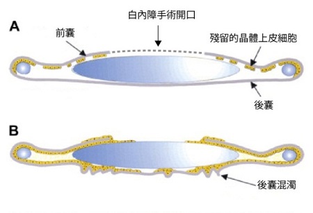 白内障