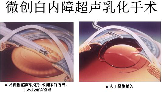 白内障