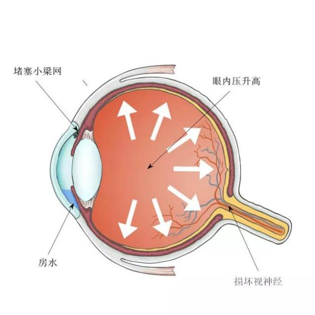 青光眼