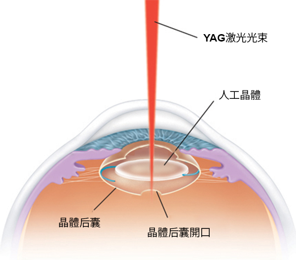 白内障